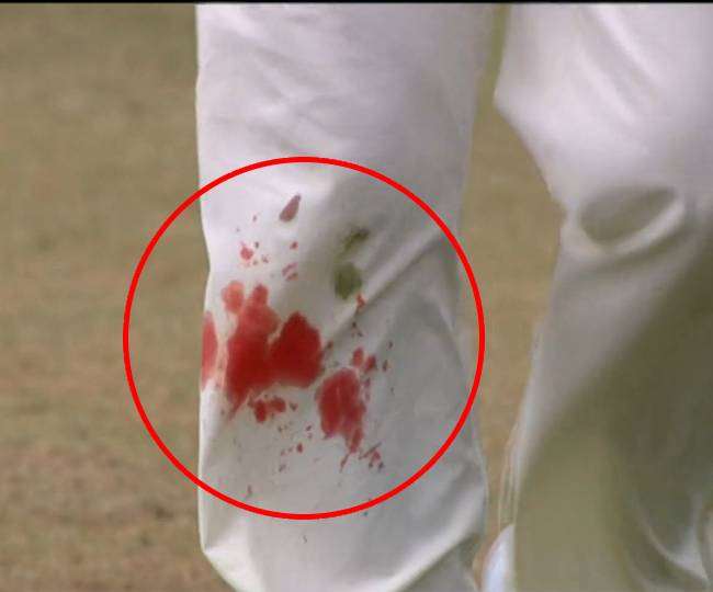 James Anderson continued to bowl despite the knee, how the British giant injury; Viral photo on social media