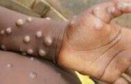 Alert in Uttar Pradesh regarding monkey pox; Patients will be screened at entry points of all districts, advisory issued